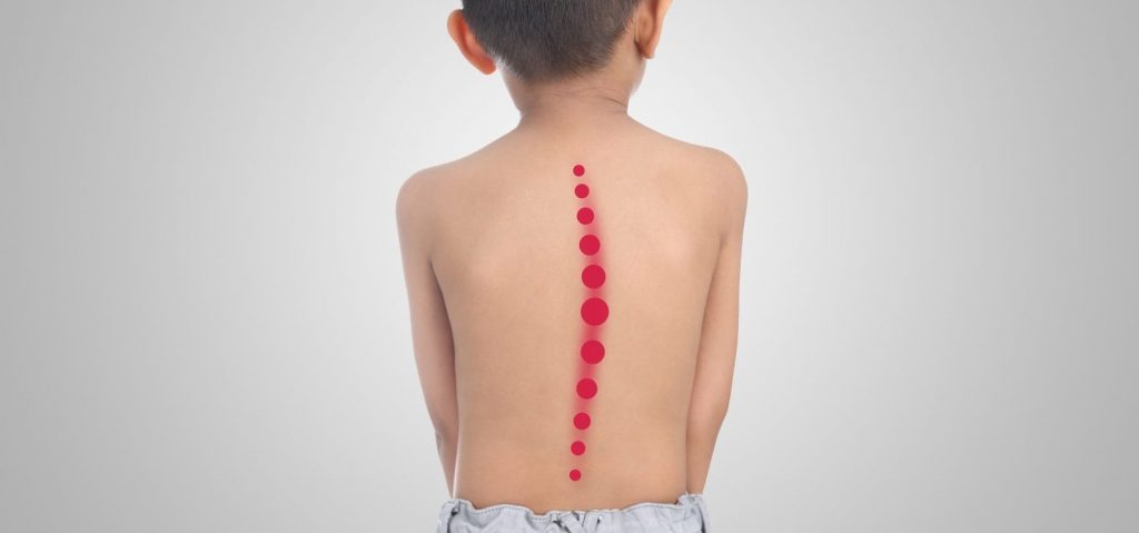 Foto de menino de costas com desenho de uma linha curva na coluna