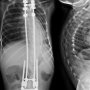 Imagens de raios-x de coluna com escoliose