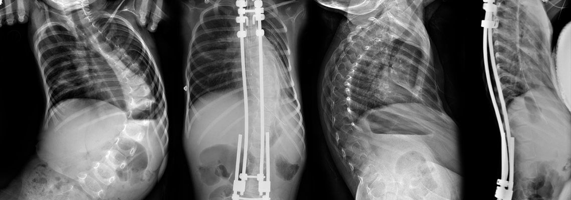 Imagens de raios-x de coluna com escoliose