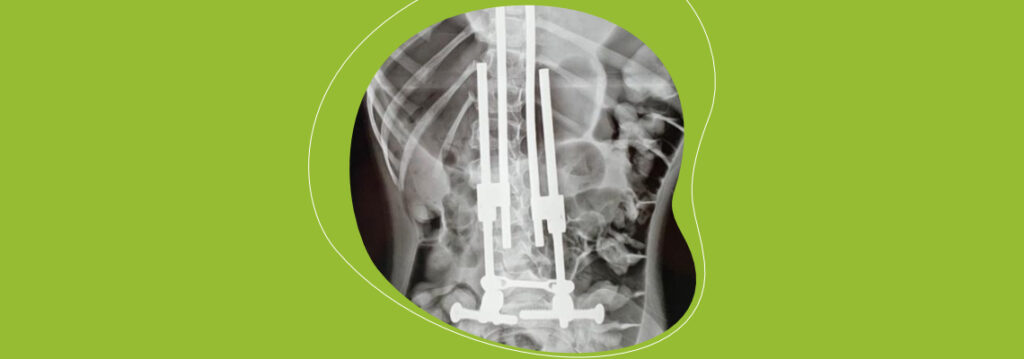 O princípio biomecânico da técnica bipolar baseia-se na fixação de dois pontos resistentes e confiáveis da coluna (distal e proximal). Utilizada para corrigir deformidades graves ou de mau prognóstico por distração [...]